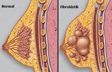Memede Kitle Belirtileri ve Tedavisi