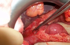 Sağ Böbrekte Kitle Belirtileri ve Tedavisi