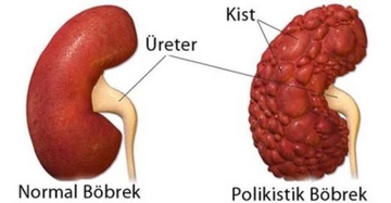 Böbrekte Kitle Nedir?